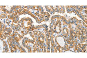Immunohistochemistry of paraffin-embedded Human thyroid cancer using CKAP4 Polyclonal Antibody at dilution of 1:50 (CKAP4 抗体)