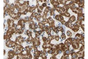 ABIN6268658 at 1/100 staining human liver cancer tissues sections by IHC-P. (PIK3CA 抗体  (Internal Region))