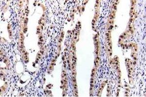 Immunohistochemistry (IHC) analyzes of p-STAT-5A antibody in paraffin-embedded human lung carcinoma tissue. (STAT5A 抗体  (pSer780))