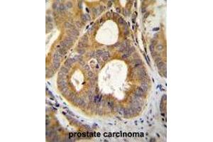 TRPM8 Antibody (N-term) immunohistochemistry analysis in formalin fixed and paraffin embedded human prostate carcinoma followed by peroxidase conjugation of the secondary antibody and DAB staining. (TRPM8 抗体  (N-Term))
