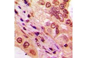 Immunohistochemical analysis of TBX10 staining in human lung cancer formalin fixed paraffin embedded tissue section. (T-Box 10 抗体)