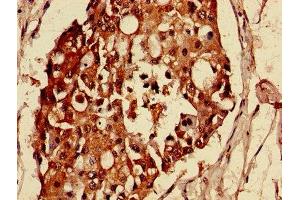 Immunohistochemistry of paraffin-embedded human breast cancer using ABIN7159021 at dilution of 1:100 (MAS1L 抗体  (AA 318-378))