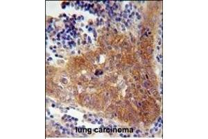 FBXW8 Antibody (Center) (ABIN654676 and ABIN2844371) immunohistochemistry analysis in formalin fixed and paraffin embedded human lung carcinoma followed by peroxidase conjugation of the secondary antibody and DAB staining.