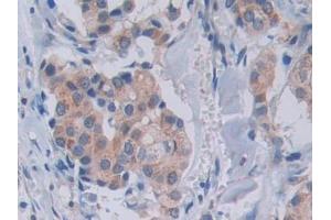 Detection of SEMA3A in Human Breast cancer Tissue using Polyclonal Antibody to Semaphorin 3A (SEMA3A) (SEMA3A 抗体  (AA 580-664))