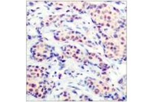 Immunohistochemistry analysis of paraffin-embedded human breast carcinoma tissue, using JunD (Ab-255) Antibody.