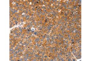 Immunohistochemical analysis of paraffin-embedded Human liver cancer tissue using at dilution 1/20. (FGF3 抗体  (C-Term))
