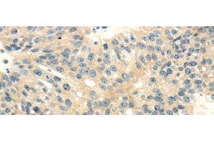 Immunohistochemistry of paraffin-embedded Human breast cancer tissue using CD70 Polyclonal Antibody at dilution 1:40 (CD70 抗体)