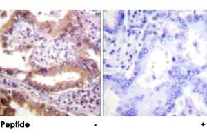 Immunohistochemical analysis of paraffin-embedded human lung carcinoma tissue using IRF3 polyclonal antibody . (IRF3 抗体)