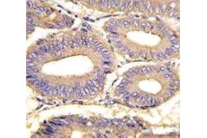 IHC analysis of FFPE human colon carcinoma tissue stained with PAK1 antibody (PAK1 抗体  (AA 401-430))