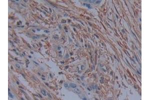 Detection of PLS3 in Human Colorectal cancer Tissue using Polyclonal Antibody to Plastin 3 (PLS3) (Plastin 3 抗体  (AA 379-630))
