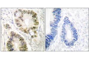 Immunohistochemical analysis of paraffin-embedded human colon carcinoma tissue using Cyclin E1 (phospho-Thr395) antibody. (Cyclin E1 抗体  (pThr395))