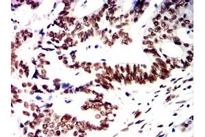 Immunohistochemical analysis of paraffin-embedded rectal cancer tissues using PMS2 mouse mAb with DAB staining. (PMS2 抗体)