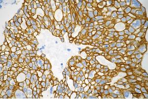 Immunohistochemistry was performed on paraffin-embedded human breast carcinoma using keratin 8 antibody (ABIN7799190), 1:200). (Recombinant KRT8 抗体)