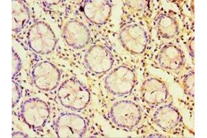 Immunohistochemistry of paraffin-embedded human colon cancer using ABIN7170823 at dilution of 1:100 (Striatin 抗体  (AA 581-780))