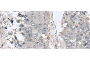 Immunohistochemistry of paraffin-embedded Human liver cancer tissue using NPHP1 Polyclonal Antibody at dilution of 1:60(x200) (NPHP1 抗体)