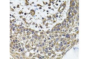 Immunohistochemistry of paraffin-embedded Human skin carcinoma using ICOSL Polyclonal Antibody at dilution of 1:100 (40x lens). (ICOSLG 抗体)