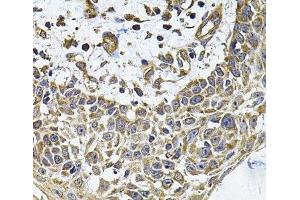 Immunohistochemistry of paraffin-embedded Human skin carcinoma using ICOSL Polyclonal Antibody at dilution of 1:100 (40x lens). (ICOSLG 抗体)