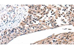 Immunohistochemistry of paraffin-embedded Human esophagus cancer tissue using Connexin-26 Polyclonal Antibody at dilution 1:100 (GJB2 抗体)