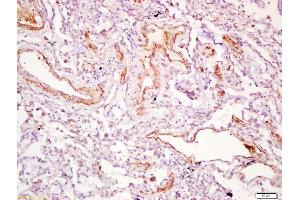 Formalin-fixed and paraffin embedded human lung carcinoma labeled with Anti-PDGF-D Polyclonal Antibody, Unconjugated (ABIN714581) at 1:200 followed by conjugation to the secondary antibody and DAB staining (PDGFD 抗体  (AA 271-370))