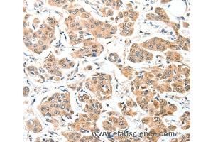 Immunohistochemistry of Human thyroid cancer using ADCK1 Polyclonal Antibody at dilution of 1:40 (ADCK1 抗体)