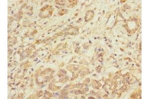 Immunohistochemistry of paraffin-embedded human pancreatic cancer using ABIN7173550 at dilution of 1:100 (Tropomodulin 1 抗体  (AA 1-359))