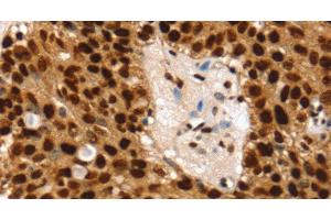 Immunohistochemistry of paraffin-embedded Human breast cancer using SSB Polyclonal Antibody at dilution of 1:30 (SSB 抗体)