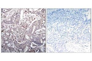 Immunohistochemical analysis of paraffin-embedded human breast carcinoma tissue, using IκB-β (Ab-23) antibody (E021304). (NFKBIB 抗体)