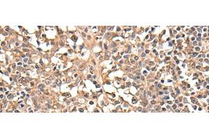 Immunohistochemistry of paraffin-embedded Human tonsil tissue using ATRIP Polyclonal Antibody at dilution of 1:40(x200) (ATRIP 抗体)