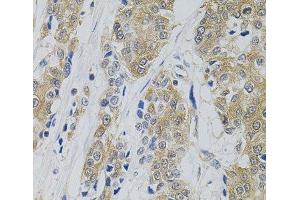 Immunohistochemistry of paraffin-embedded Human prostate cancer using DNM2 Polyclonal Antibody (DNM2 抗体)