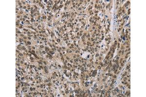 Immunohistochemistry of Human esophagus cancer using IRF9 Polyclonal Antibody at dilution of 1:50 (IRF9 抗体)
