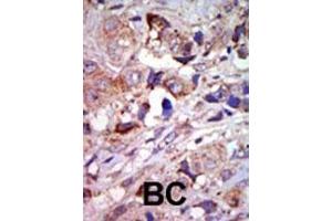 Formalin-fixed and paraffin-embedded human cancer tissue reacted with the primary antibody, which was peroxidase-conjugated to the secondary antibody, followed by AEC staining. (MAP3K12 抗体  (C-Term))
