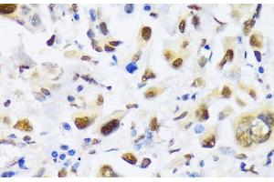 Immunohistochemistry of paraffin-embedded Human lung cancer using EP300 Polyclonal Antibody at dilution of 1:100 (40x lens). (p300 抗体)