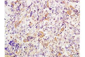 Formalin-fixed and paraffin embedded human osteosarcoma tissue labeled with Anti-Twist Polyclonal Antibody , Unconjugated at 1:200 followed by conjugation to the secondary antibody, (SP-0023), and DAB staining (TWIST1, TWIST2 (AA 71-170) 抗体)