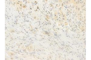 ABIN7095868 and ABIN7099930 at 1/100 staining human tongue carcinoma by IHC-P.