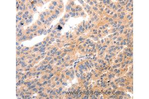 Immunohistochemistry of Human ovarian cancer using MYL9 Polyclonal Antibody at dilution of 1:80