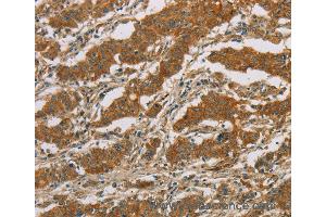 Immunohistochemistry of Human gastic cancer using CYP39A1 Polyclonal Antibody at dilution of 1:50