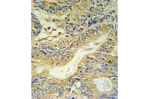 PYY Antibody IHC analysis in formalin fixed and paraffin embedded colon carcinoma followed by peroxidase conjugation of the secondary antibody and DAB staining. (Peptide YY 抗体  (C-Term))