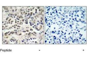 Immunohistochemical analysis of paraffin-embedded human lung carcinoma tissue using CDKN1B polyclonal antibody  . (CDKN1B 抗体  (Ser10))