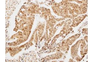 IHC-P Image Immunohistochemical analysis of paraffin-embedded OVCA xenograft, using LIMD1, antibody at 1:300 dilution. (LIMD1 抗体  (C-Term))