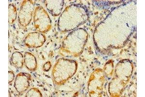 Immunohistochemistry of paraffin-embedded human gastric cancer using ABIN7142369 at dilution of 1:100 (MRPL2 抗体  (AA 61-305))