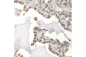 Immunohistochemistry of paraffin-embedded human thyroid cancer using GTF2F1 antibody (ABIN5971324) at dilution of 1/200 (40x lens).