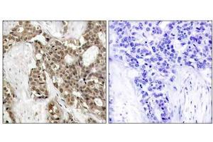 Immunohistochemical analysis of paraffin-embedded human breast carcinoma tissue, using p44/42 MAP Kinase (phospho-Tyr204) antibody (E011246). (ERK1/2 抗体  (pTyr204))