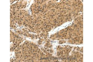 Immunohistochemistry of Human liver cancer using TERF2 Polyclonal Antibody at dilution of 1:30 (TRF2 抗体)