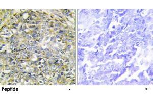 Immunohistochemistry analysis of paraffin-embedded human lung carcinoma tissue using UBXN11 polyclonal antibody . (UBXN11 抗体)