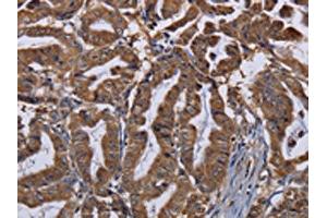The image on the left is immunohistochemistry of paraffin-embedded Human esophagus cancer tissue using ABIN7130206(MCTS1 Antibody) at dilution 1/30, on the right is treated with fusion protein. (MCTS1 抗体)