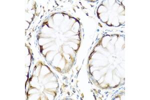 Immunohistochemistry of paraffin-embedded human colon using APCS antibody (ABIN5971040) at dilution of 1/100 (40x lens). (APCS 抗体)
