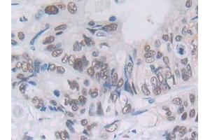 Detection of PLCg1 in Human Colorectal cancer Tissue using Polyclonal Antibody to Phospholipase C Gamma 1 (PLCg1)