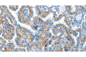 Immunohistochemistry of paraffin-embedded Human thyroid cancer tissue using COG1 Polyclonal Antibody at dilution 1:60 (COG1 抗体)
