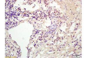 Formalin-fixed and paraffin embedded human colon carcinoma labeled with Rabbit Anti KIF11/Eg5/TRIP5 Polyclonal Antibody, Unconjugated (ABIN872373) at 1:200 followed by conjugation to the secondary antibody and DAB staining