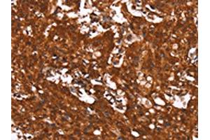 The image on the left is immunohistochemistry of paraffin-embedded Human gastic cancer tissue using ABIN7190910(HCAR2 Antibody) at dilution 1/40, on the right is treated with synthetic peptide. (HCAR2 抗体)